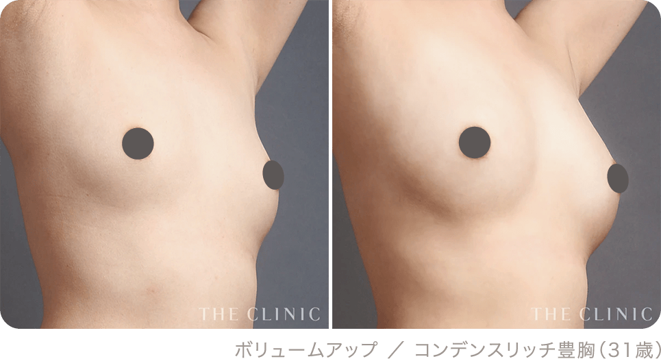 ボリュームアップ ／ コンデンスリッチ豊胸（31歳）
