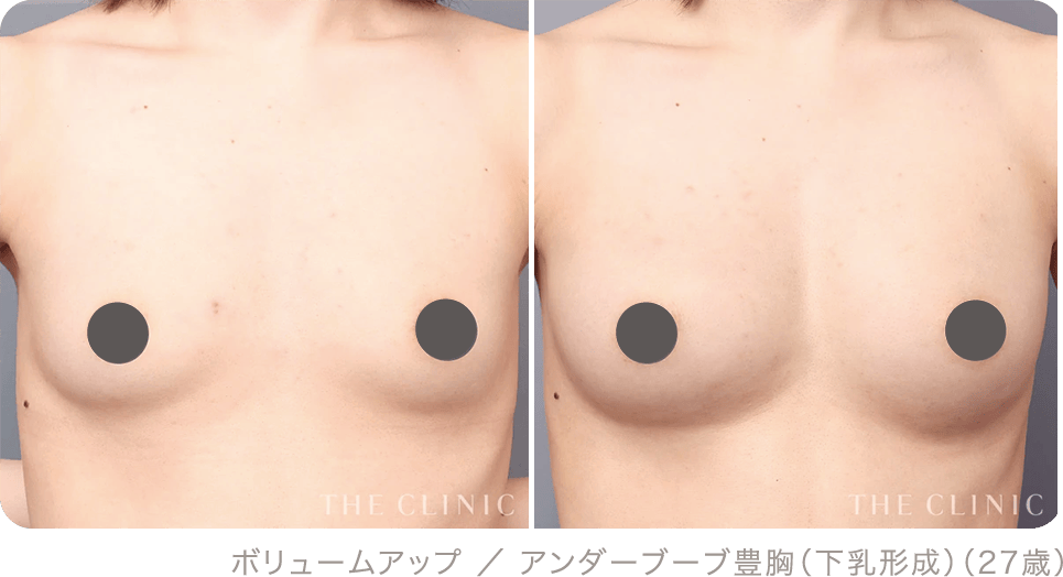 ボリュームアップ ／ アンダーブーブ豊胸（下乳形成）（27歳）