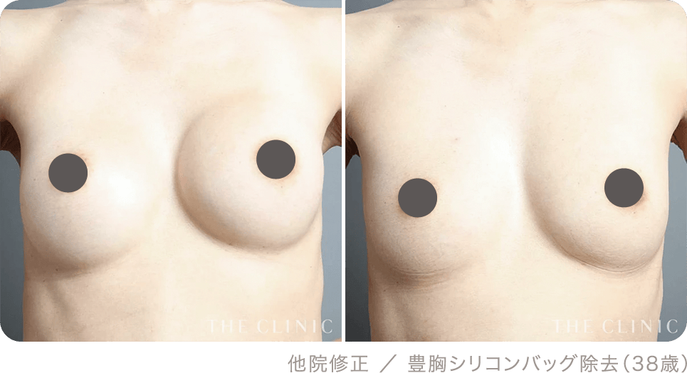 他院修正 ／ 豊胸シリコンバッグ除去（38歳）