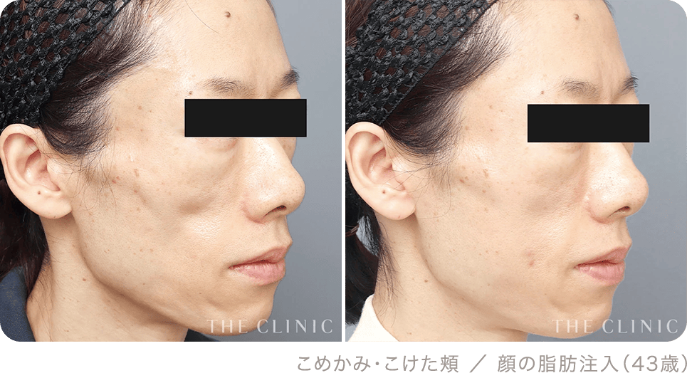 こめかみ・こけた頬 ／ 顔の脂肪注入（43歳）