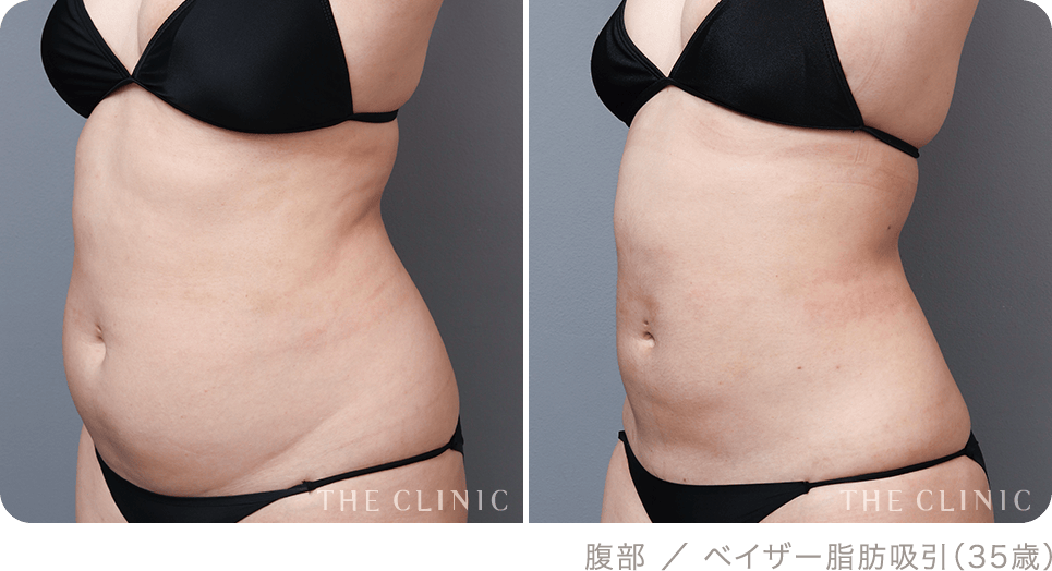 腹部 ／ ベイザー脂肪吸引（35歳）