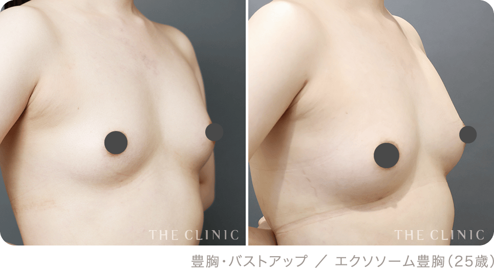 豊胸・バストアップ ／ エクソソーム豊胸（25歳）