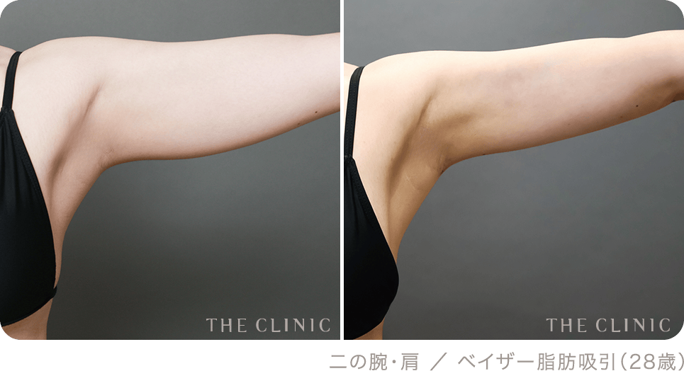二の腕・肩 ／ ベイザー脂肪吸引（28歳）