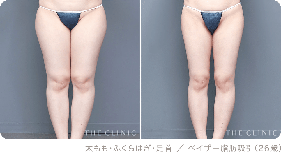太もも・ふくらはぎ・足首 ／ ベイザー脂肪吸引（26歳）