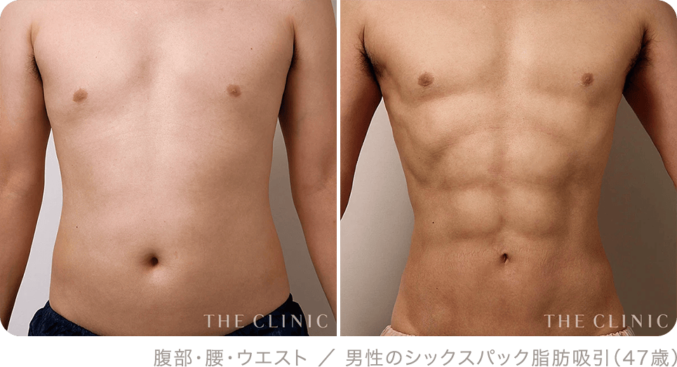 腹部・腰・ウエスト ／ 男性のシックスパック脂肪吸引（47歳）