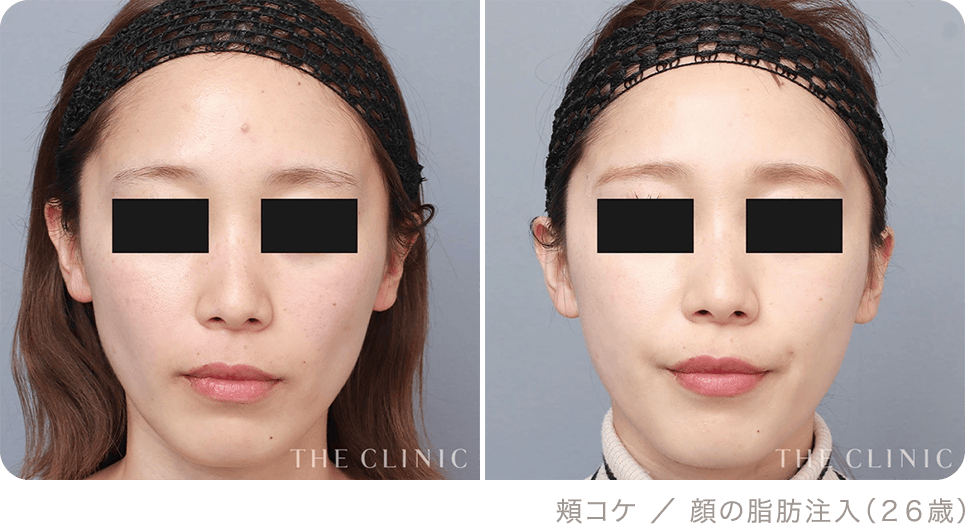 頬コケ ／ 顔の脂肪注入（２６歳）