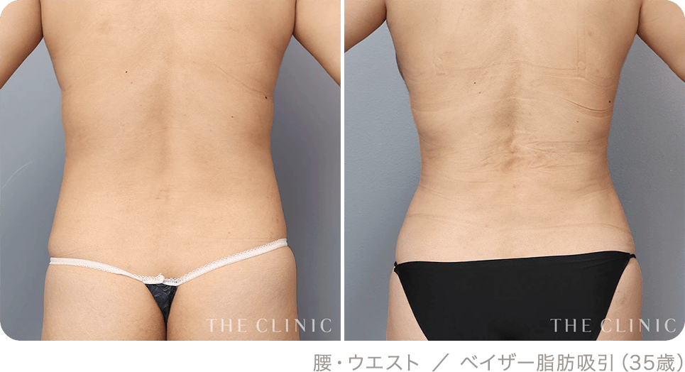 腰・ウエスト ／ ベイザー脂肪吸引（35歳）