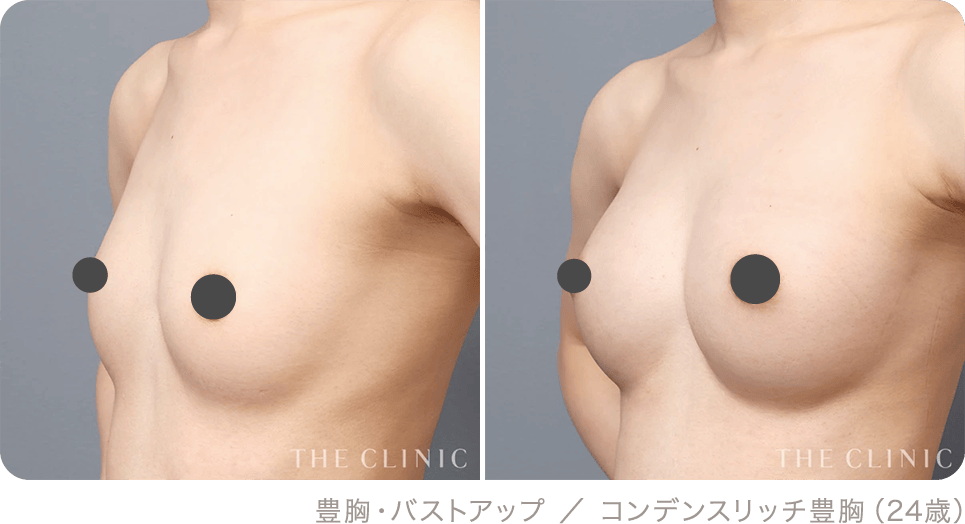豊胸・バストアップ ／ コンデンスリッチ豊胸（24歳）