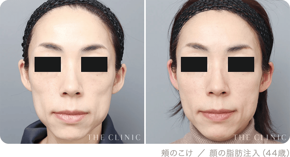 頬のこけ ／ 顔の脂肪注入（44歳）
