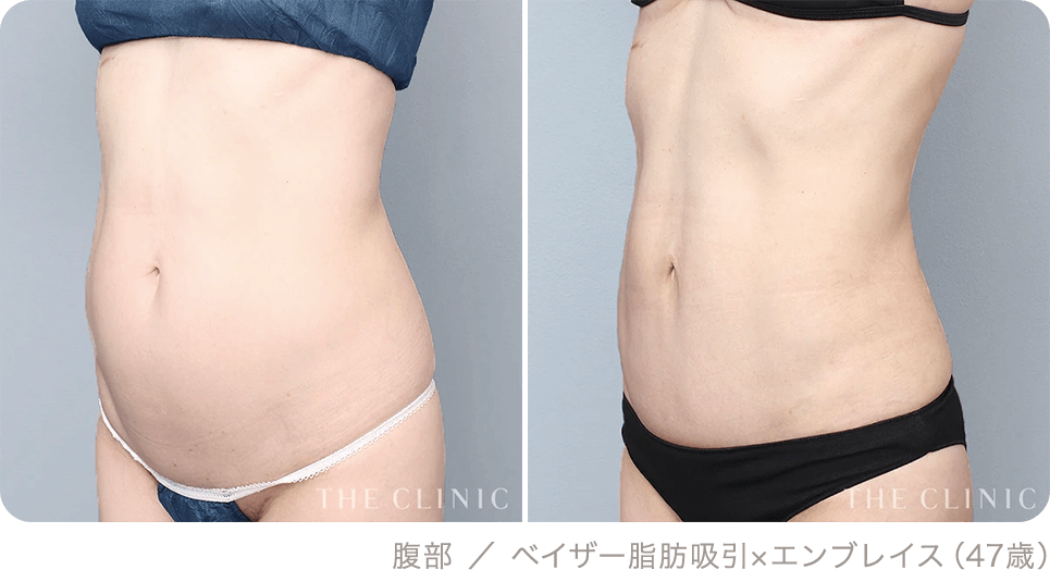 腹部 ／ ベイザー脂肪吸引×エンブレイス（47歳）