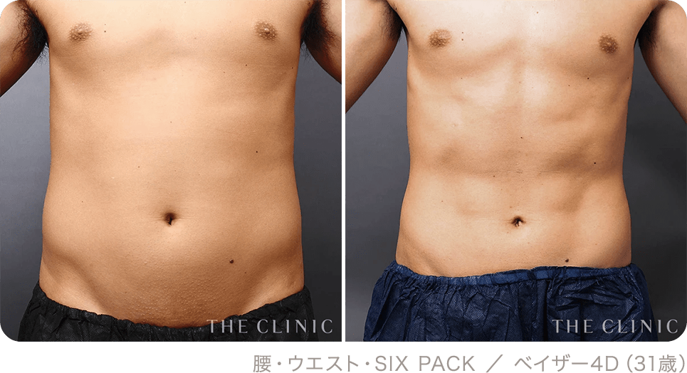 腰・ウエスト・SIX PACK ／ ベイザー4D（31歳）
