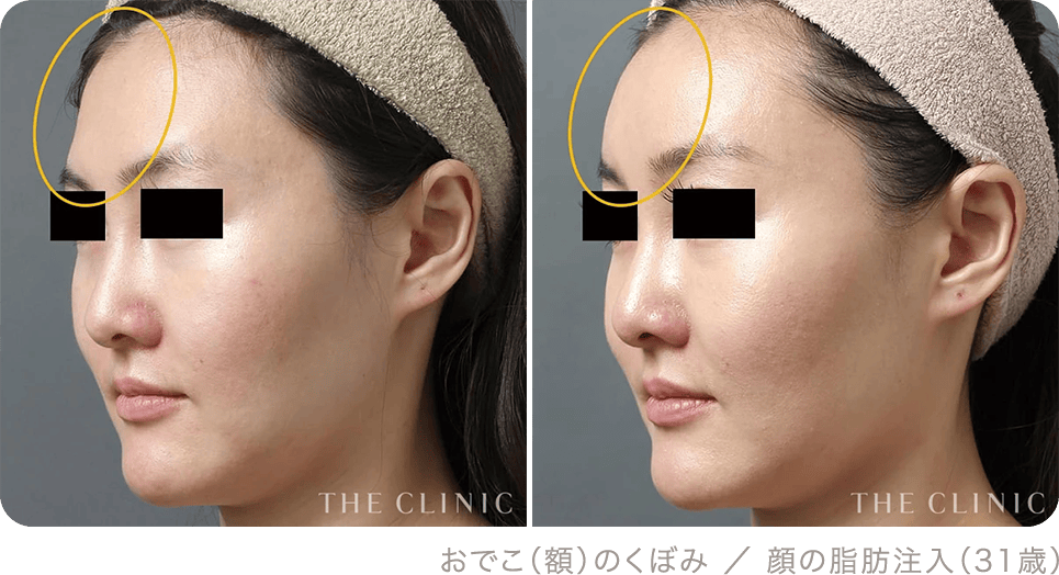 おでこ（額）のくぼみ ／ 顔の脂肪注入（31歳）