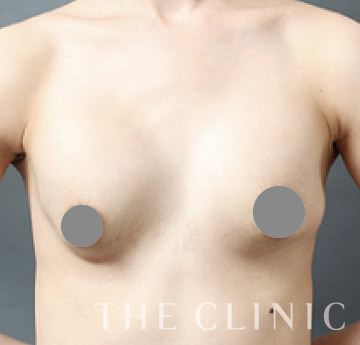 豊胸シリコンバッグの失敗修正 The Clinic 公式