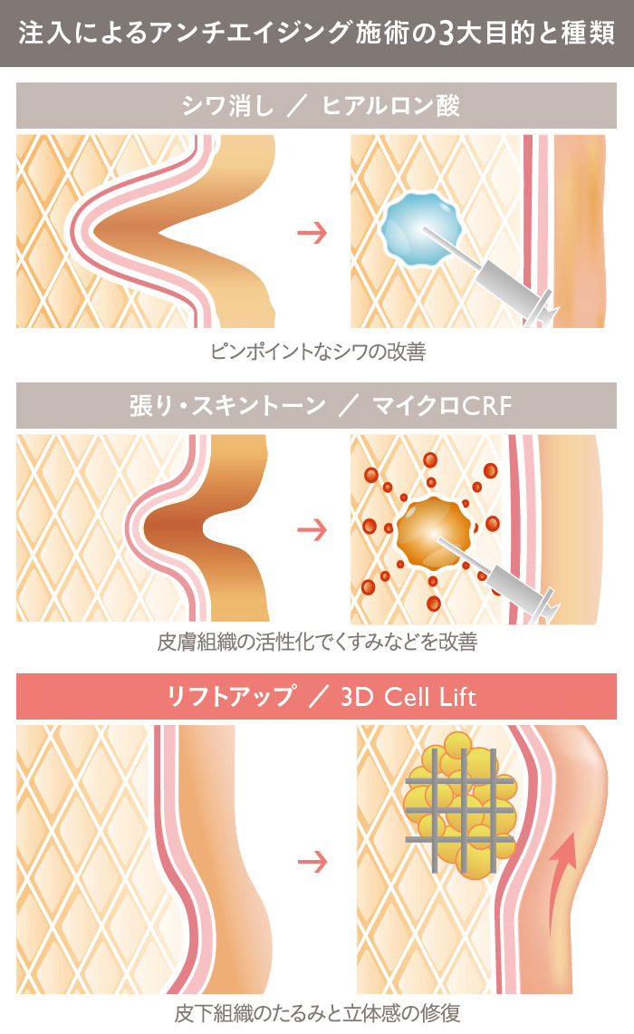 3Dセルリフト（切らないフェイスリフト）｜THE CLINIC【公式】