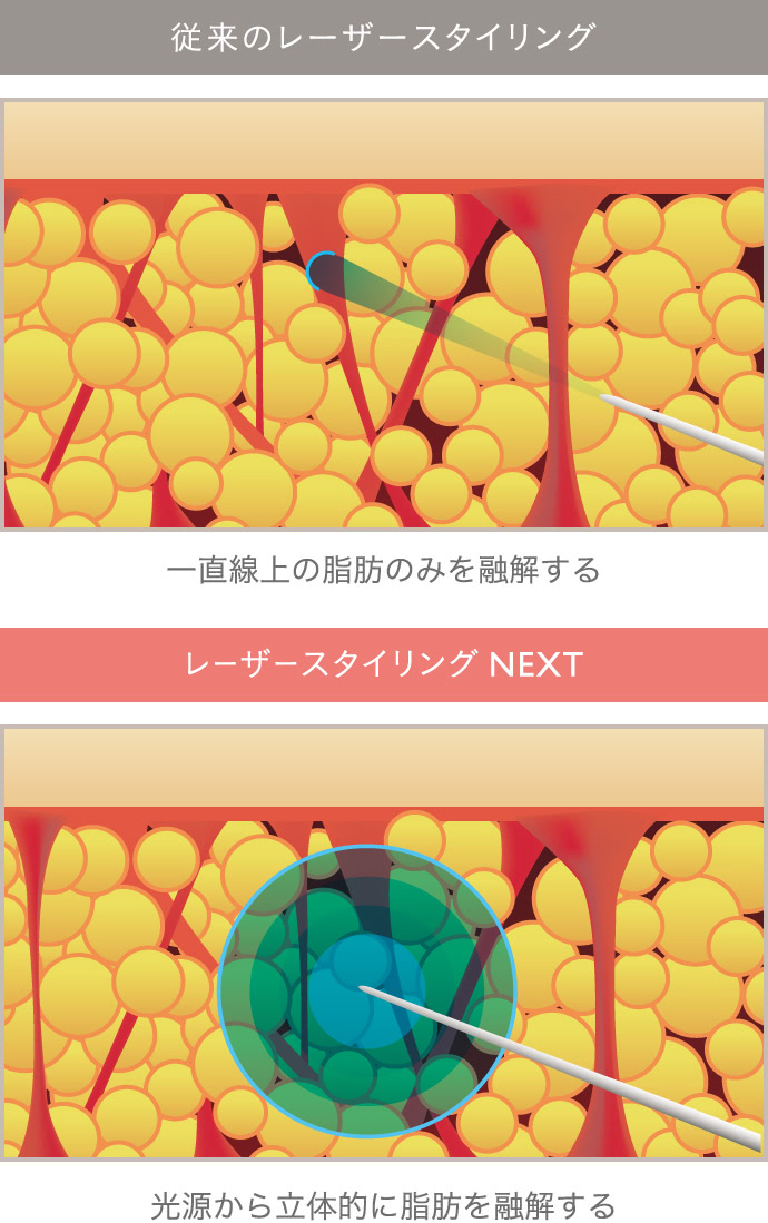 レーザースタイリングnext The Clinic 公式 レーザースタイリングnext The Clinic 公式