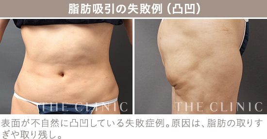 ヒアルロン酸＋安全で失敗しない脂肪吸引の手術 THE CLINIC ヒアルロン酸＋安全で失敗しない脂肪吸引の手術 THE CLINIC 安全で失敗