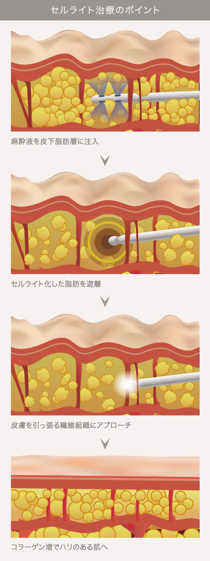 ベイザースムース セルライト除去 The Clinic 公式