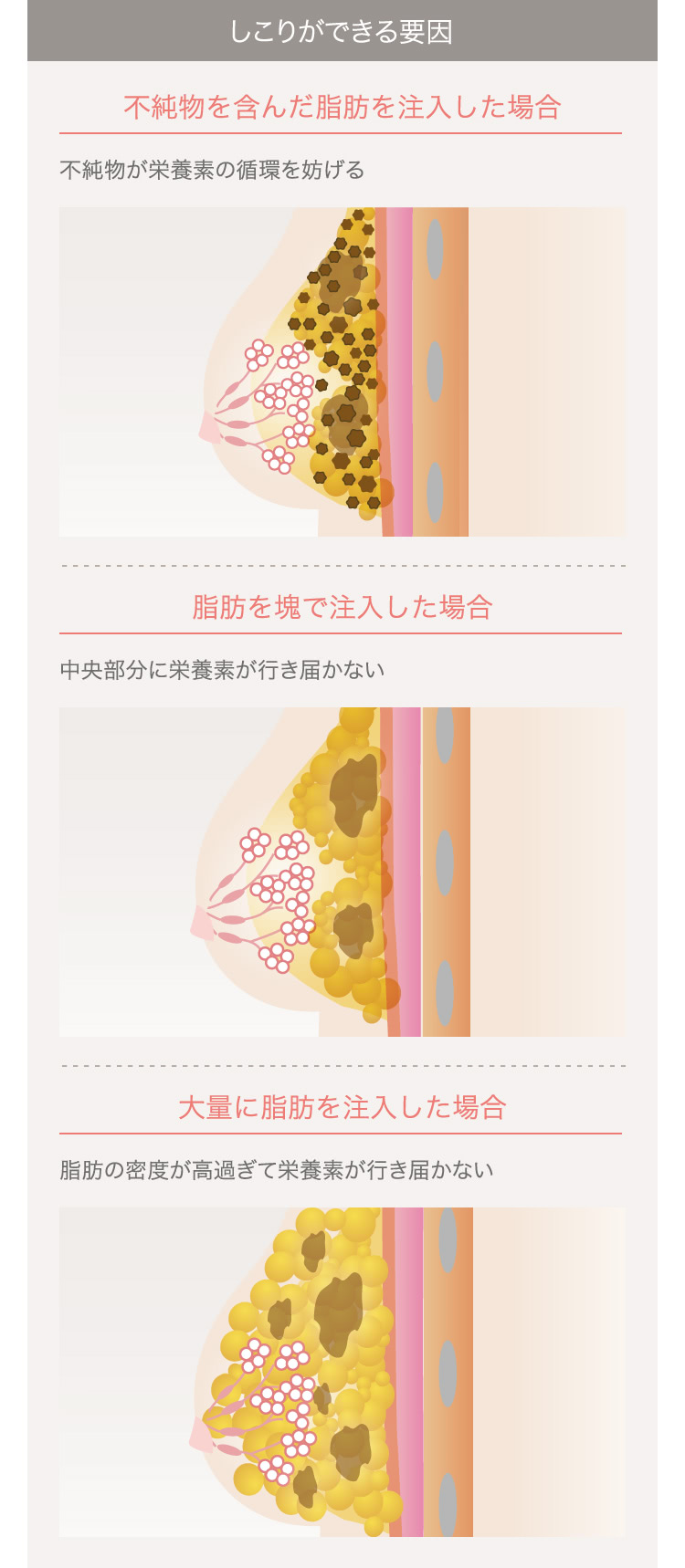 脂肪注入豊胸後のしこりのお悩み The Clinic ザクリニック 公式