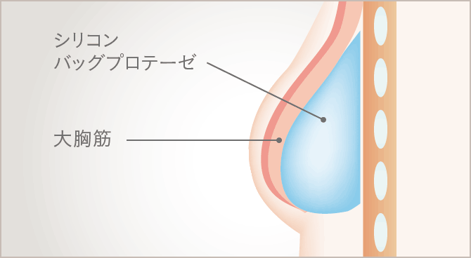乳がん術後の乳房再建｜THE CLINIC（ザクリニック）【公式】