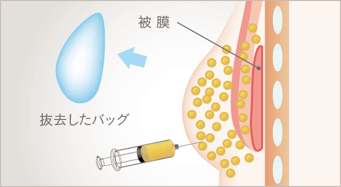 乳がん術後の乳房再建｜THE CLINIC（ザクリニック）【公式】