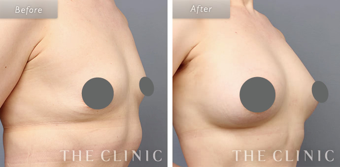 授乳後 産後の胸のたるみの解消法 The Clinic ザクリニック 公式 授乳後 産後の胸のたるみの解消法 The Clinic ザクリニック 公式