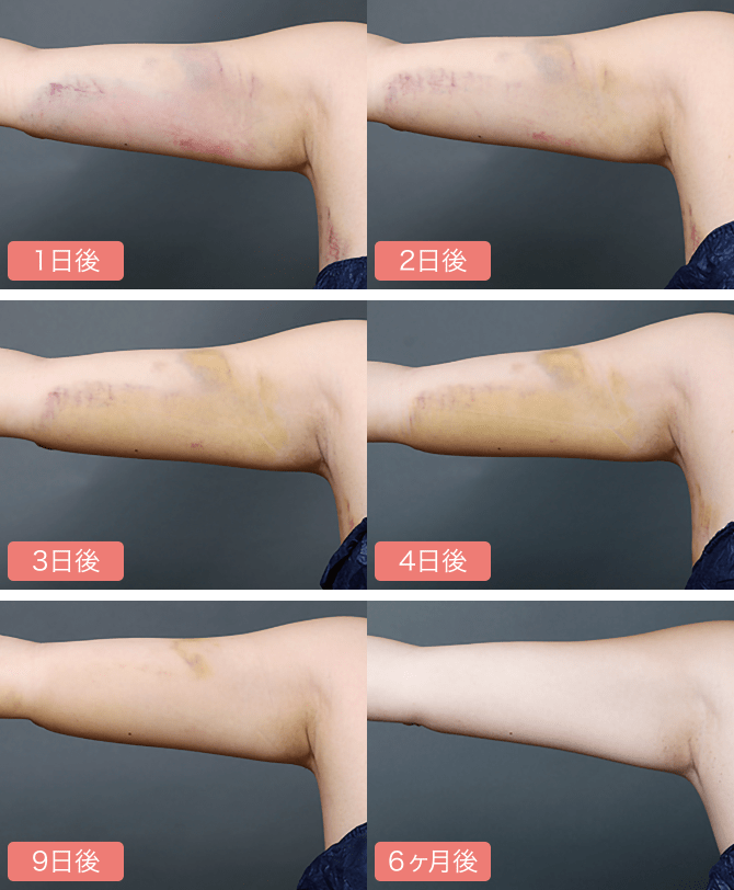 二の腕・肩の脂肪吸引｜脂肪吸引専門のTHE CLINIC