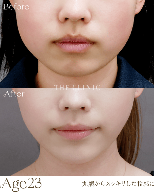 Age 23 | 丸顔からスッキリした輪郭に