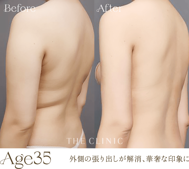 Age 35 | 外側の張り出しが解消、華奢な印象に