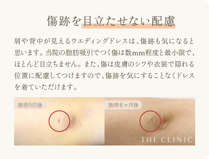 傷跡を目立たせない配慮 | 肩や背中が見えるウエディングドレスは、傷跡も気になると思います。 当院の脂肪吸引でつく傷は数mm程度と最小限で、ほとんど目立ちません。 また、傷は皮膚のシワや衣装で隠れる位置に配慮してつけますので、傷跡を気にすることなくドレスを着ていただけます。