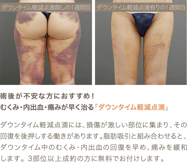 術後が不安な方におすすめ！むくみ・内出血・痛みが早く治る「ダウンタイム軽減点滴」 ダウンタイム軽減点滴には、損傷が激しいl部位に集まり、その回復を後押しする働きがあります。脂肪吸引と組み合わせると、ダウンタイム中のむくみ・内出血の回復を早め、痛みを緩和します。3部位以上成約の方に無料でお付けします。