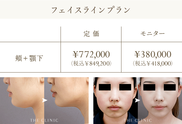 フェイスラインプラン | 頬＋顎下: 定価 ¥772,000（税込￥849,200） / モニター: ¥380,000（税込￥418,000）