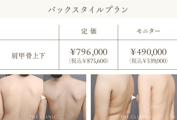 バックスタイルプラン | 肩甲骨上下: 定価 ¥796,000（税込￥875,600） / モニター: ¥490,000（税込￥539,000）