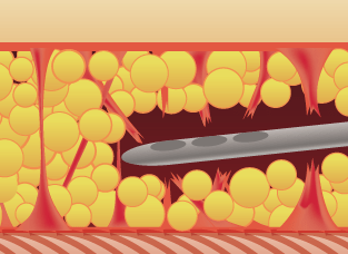 セルライトの除去 The Clinic ザクリニック 公式