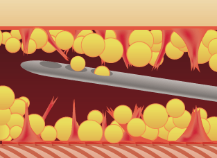 セルライトの除去 The Clinic ザクリニック 公式