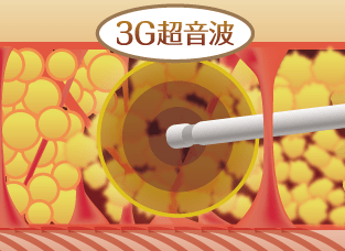 セルライトの除去 The Clinic ザクリニック 公式