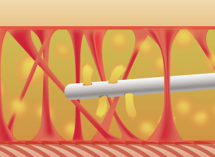 セルライトの除去 The Clinic ザクリニック 公式