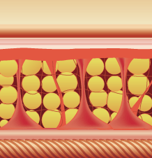 セルライトの除去 The Clinic ザクリニック 公式