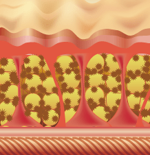 セルライトの除去 The Clinic ザクリニック 公式