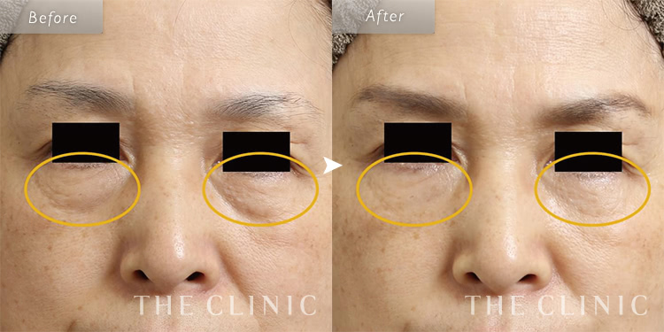 乾燥にがだま　クマ ごめんね素肌 クマらないアイクリーム | クリアターン[CLEAR TURN]