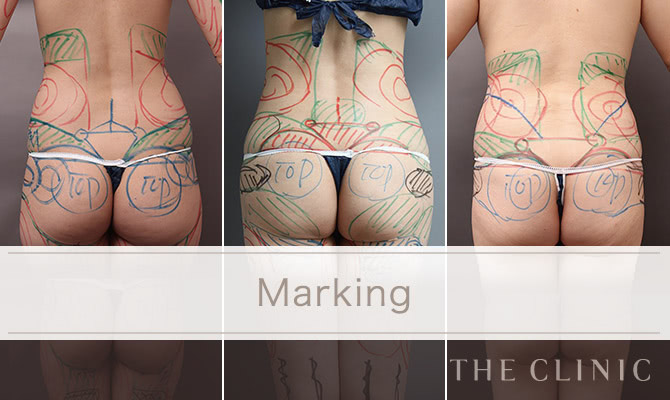 お尻の脂肪吸引 豊尻 The Clinic ザクリニック 公式