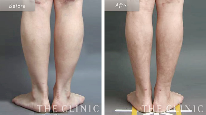 ふくらはぎの脂肪吸引 The Clinic ザクリニック 公式 ふくらはぎの脂肪吸引 The Clinic ザクリニック 公式