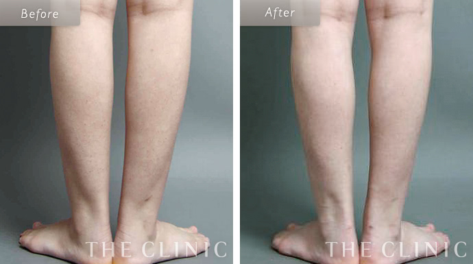 ふくらはぎの脂肪吸引 The Clinic ザクリニック 公式 ふくらはぎの脂肪吸引 The Clinic ザクリニック 公式
