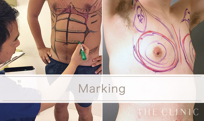 男性の脂肪吸引 The Clinic ザクリニック 公式