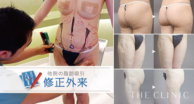 THE CLINIC ザクリニック　ガードル　脂肪吸引　豊胸　圧迫着　着圧着 豊胸手術・バストアップ｜豊胸専門の美容外科THE CLINIC(ザ
