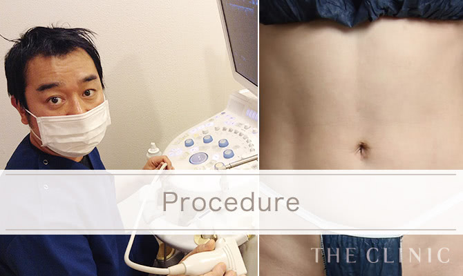 お腹の脂肪吸引｜脂肪吸引専門のTHE CLINIC