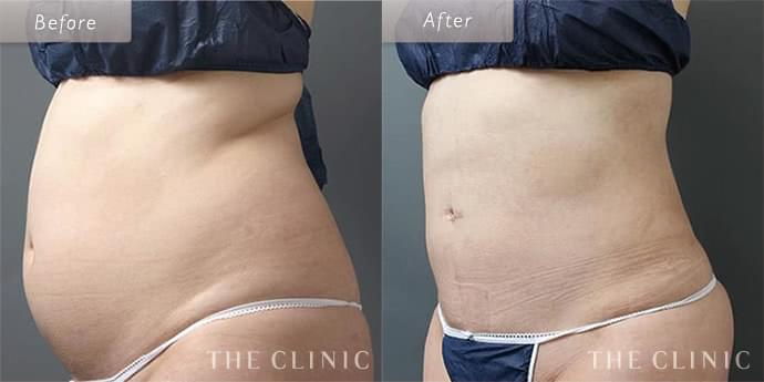 【美品】THE CLINIC ザクリニック脂肪吸引 圧迫着 お腹・腰・ウエスト THE CLINICの脂肪吸引後圧迫着ガードル（医療用）