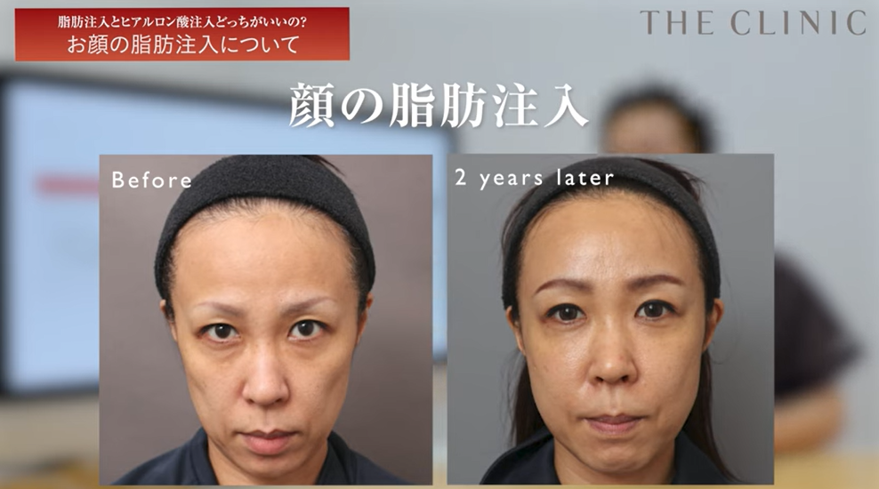 顔の脂肪注入によるエイジング治療の症例