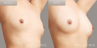 痩せ型の脂肪注入豊胸の症例写真