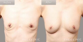 痩せ型の脂肪注入豊胸の症例写真