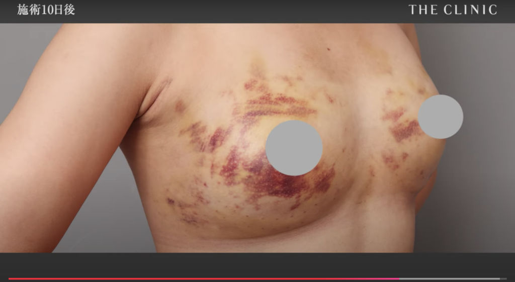 脂肪豊胸のダウンタイム（10日後、内出血）